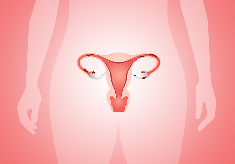 Endometriozis - Novafertil