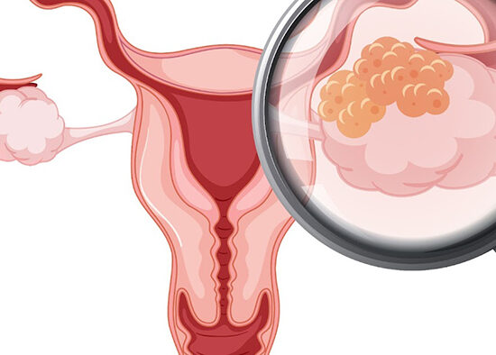 Dermoid Kist Nedir? - Nova Fertil