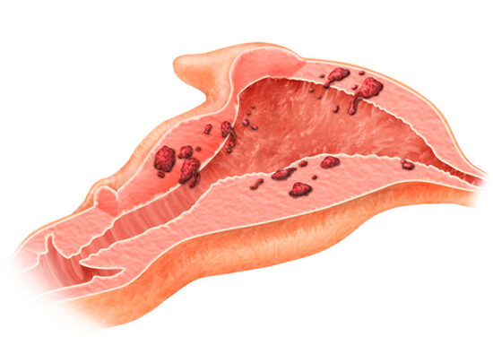 Adenomyozis Nedir? - Nova Fertil